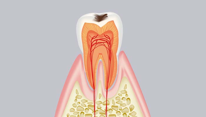 C1：エナメル質内の虫歯