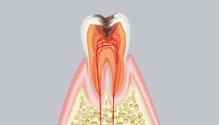 C3：歯髄(神経)に達した虫歯 