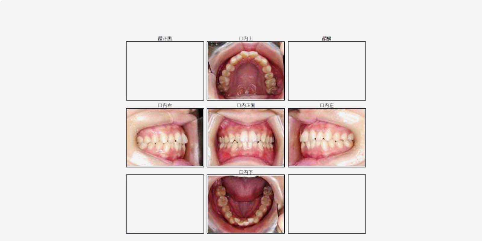 口腔内画像